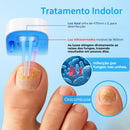 Aparelho Anti-Micose A Laser | A Solução Definitiva para Unhas com Fungos